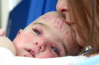 بیماری پروانه‌ای، نوعی بیماری نادر پوستی با نام علمی «اپیدرمولیزیس بولوسا» ( epidermolysis bullosa) است که به دلیل جهش در ژن مسؤول بازسازی پوست ایجاد می‌شود.